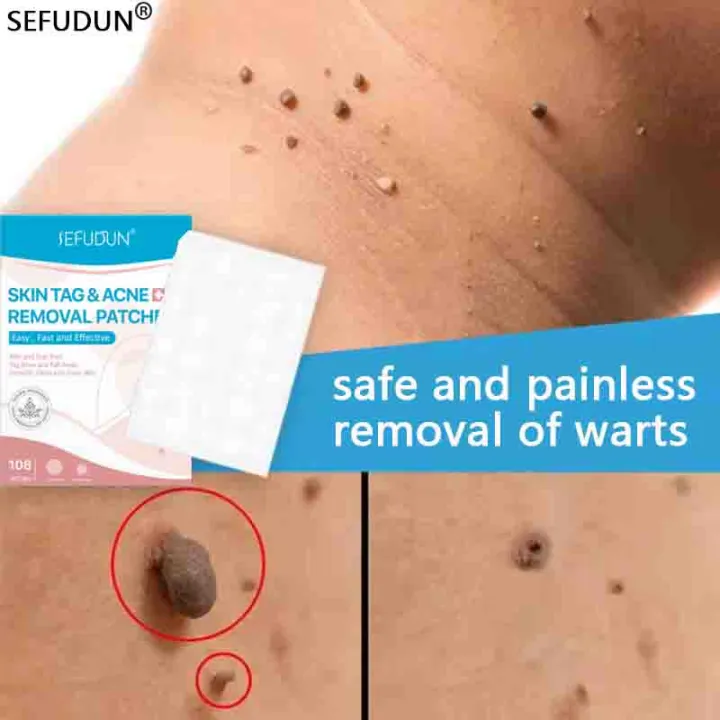 Effectively remove and treat warts！SEFUDUN Wart Patch Detox patch to remove warts Analgesic