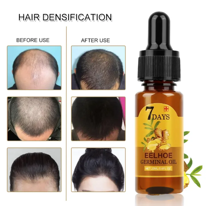 【ready Stock】 Eelhoe Effective Ginger Germinal Oil Hair Growth