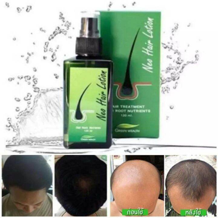 Neo Hair Lotion Hair Grower Treatment Lazada PH