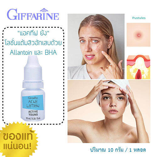 hot-sale-กำจัดสิวหน้าไม่พังด้วยกิฟฟารืนโลชั่นแต้มสิวแอคทิฟยัง-ปริมาณ-10-กรัม-1กระปุก-รหัส22101-lung-d-ของแท้100