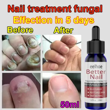 Tea Tree Oil for Nail Fungus: How-to, Does It Work, and Is It Safe
