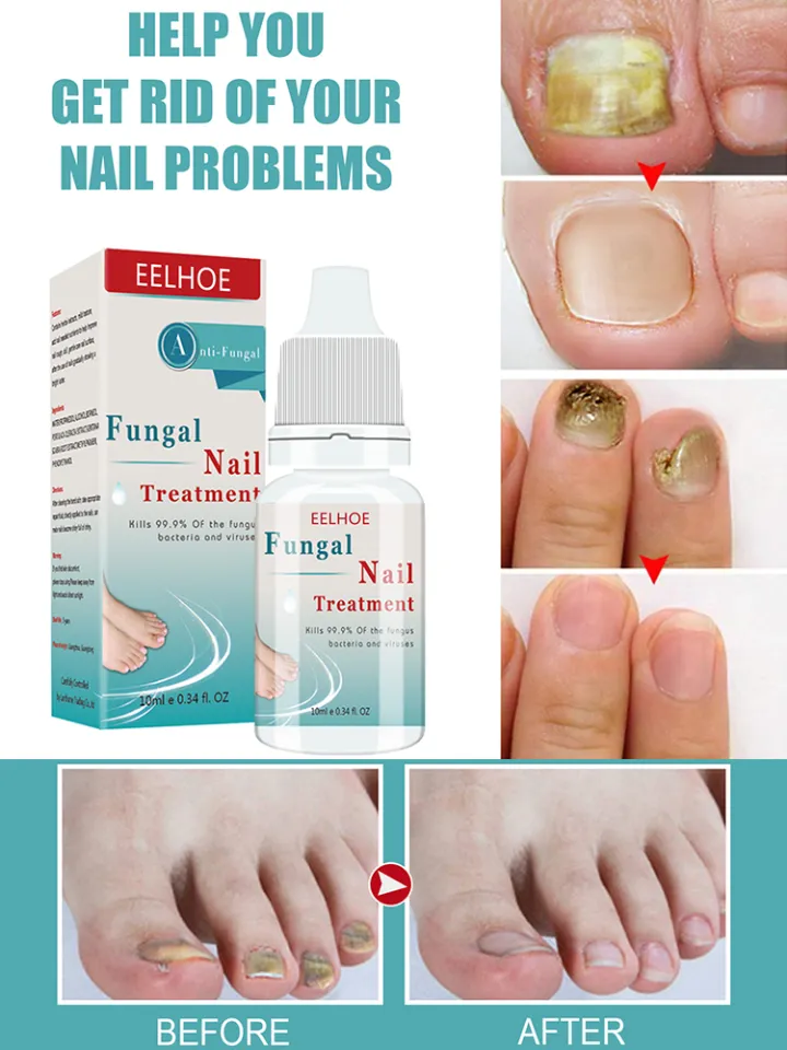 Fungal Nail Infections — DermNet