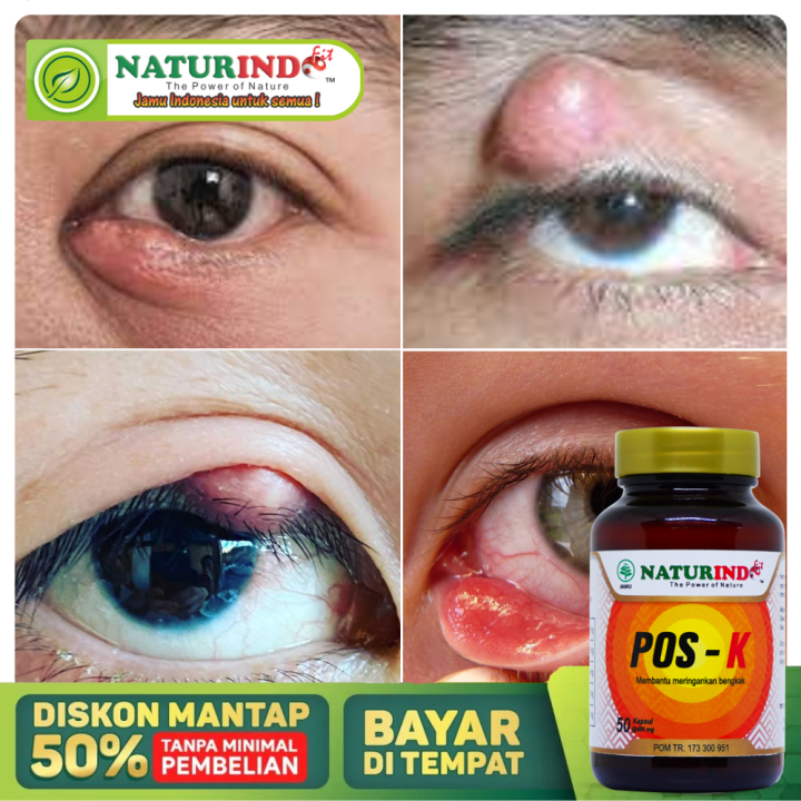 Obat Kalazion Kelopak Mata, Obat Benjolan Mata Paling Ampuh, Mata ...