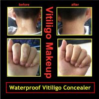 Vitiligo Makeup Concealer Waterproof Cover Up Pen Long Lasting Natural Liquid On Face Hands For Women Men Kids