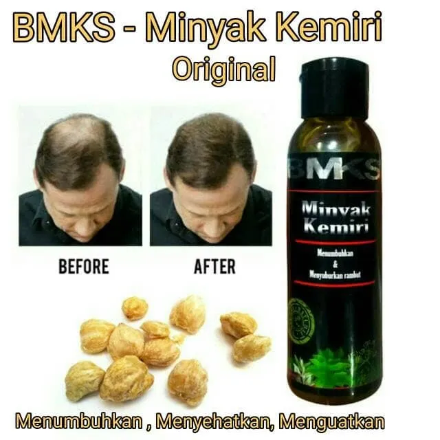 Penumbuh Rambut Botak Pria Wanita Minyak Kemiri Asli Penumbuh Rambut Original 100 Resmi Bpom Minyak