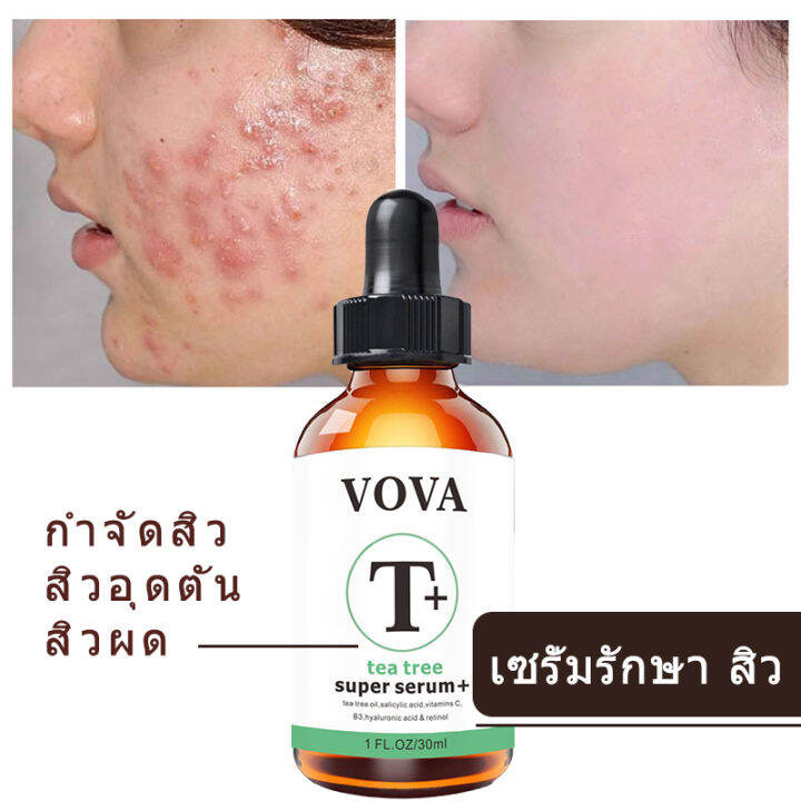 เซรั่มรักษา สิว Tea Tree Vova ครีมรักษา สิว ลด สิวหาย ให้ผิวสวยกลับมา  เจลแต้ม สิว เซรั่มลด สิว ครีมแต้ม สิว ลด รอยดำจาก สิว เซรั่ม หน้าใส |  Lazada.Co.Th