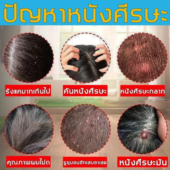 แชมพูขจัดรังแค-แชมพูสระผม-ยาสระผมเชื้อรา-แชมพูยาขจัดรังแค-มีรังแค-ป้องกันรังแค-ขจัดไร-ควบคุมความมันและอาการคัน-ครีมสระผม-ครีมขจัดรังแค-ยาสระผม-shampoo-แชมพูแก้ผมร่วง-500ml