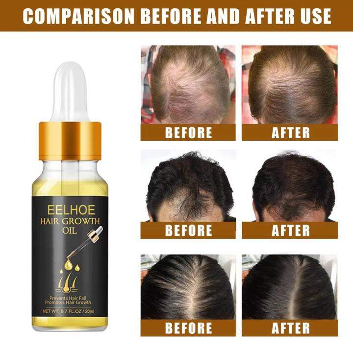 EELHOE HAIR GROWTH OIL PREVENTS HAIR FALL | Lazada PH