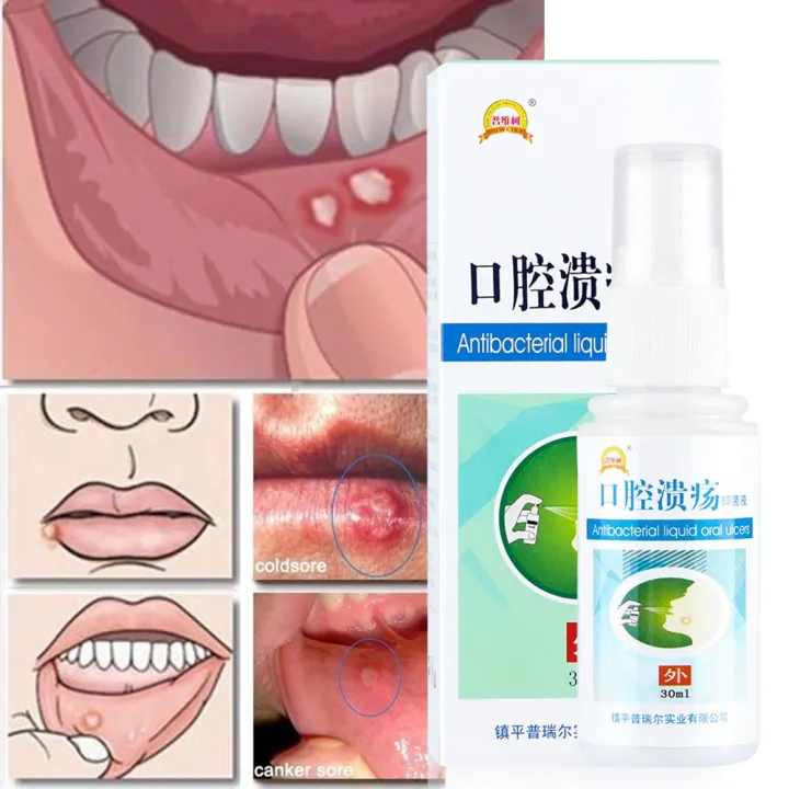 30ML Natural Mouth Ulcer Pain Relief Spray Anti Bacterial Hygiene
