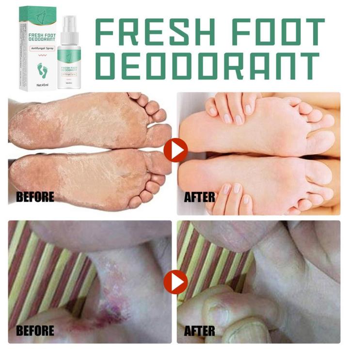 ในสต็อก-เท้ากลิ่นสเปรย์-antibacterials-ระงับกลิ่นกายสมุนไพร-สาระสำคัญป้องกันคันเหงื่อกลิ่นฟุตนักกีฬาเท้าของเหลวป้องกันเชื้อรารองเท้าฟุต