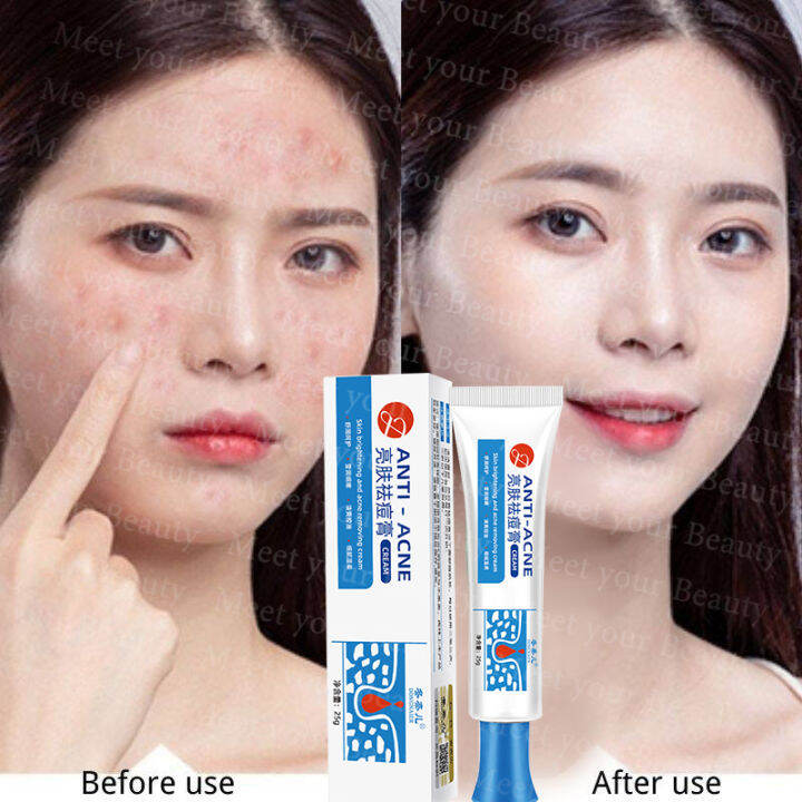 100 Effective Remove Pimples Quickly Pimple Remover Acne Cream Fades