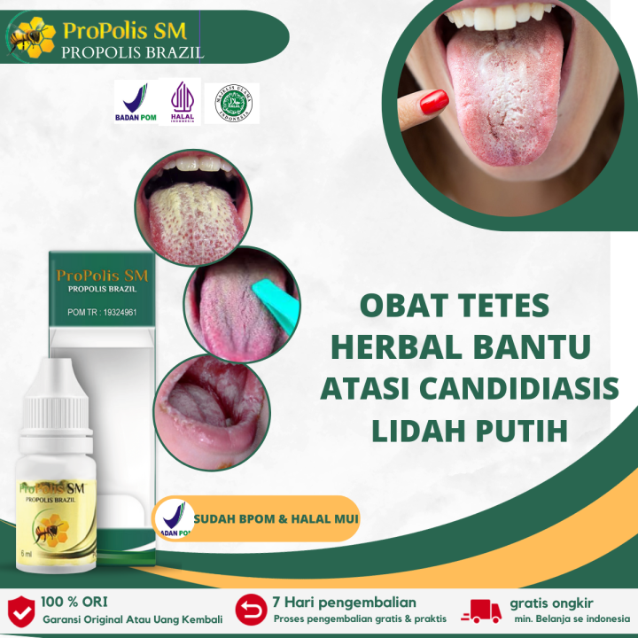 Propolis Sm Obat Kandiasis Obat Lidah Putih Berjamur Obat Radang Lidah Mulut Terasa Pahit 8126