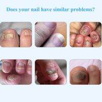 Nail Care -Fungal Solution 4 ชิ้น Toenail Antifungal Care Essence Pen สำหรับต่อต้านเชื้อราที่เล็บ ฟื้นฟูเล็บเท้าให้เรียบเนียน แดงก่ำ สุขภาพดีเป็นมัน