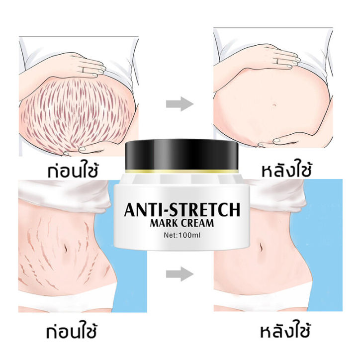 ข้อเสนอจำกัดเวลา-aichun-100ml-ครีมรอยแตกลาย-ครีมบำรุง-ยกกระชับฟื้นฟูและชุ่มชื้น-ครีมทาท้องแตกลาย-ครีมทาแตกลาย-ครีมลบรอยแตก-ครีมทาท้องลาย-ครีมลบรอยแตกลาย-ยาทาแก้ขาลาย-ครีมแก้ท้องลาย-ครีมลดรอยแตกลาย-ครี