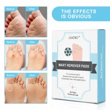 Callus Removal Singapore  Foot Corn Removal Singapore