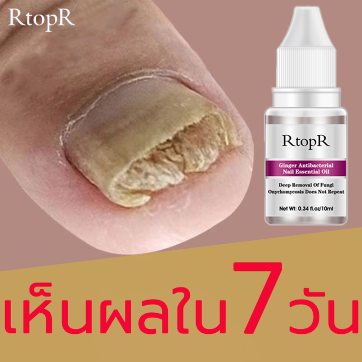 เห็นผลภายใน7วัน-rtopr-รักษาเล็บ-เล็บเท้าคุณภาพสูงกำจัดเชื้อราที่เล็บ-เอ็สเซ้นซ่อมแซมเล็บเสีย-รักษารคเชื้อราที่เล็บ-เล็บพัง-เล็บขบ-เซรั่มบำรุงเล็บ-น้ำมันบำรุงเล็บ-ดูแลเล็บ-เชื้อราเล็บมือ-น้ำยารักษาเล็บ