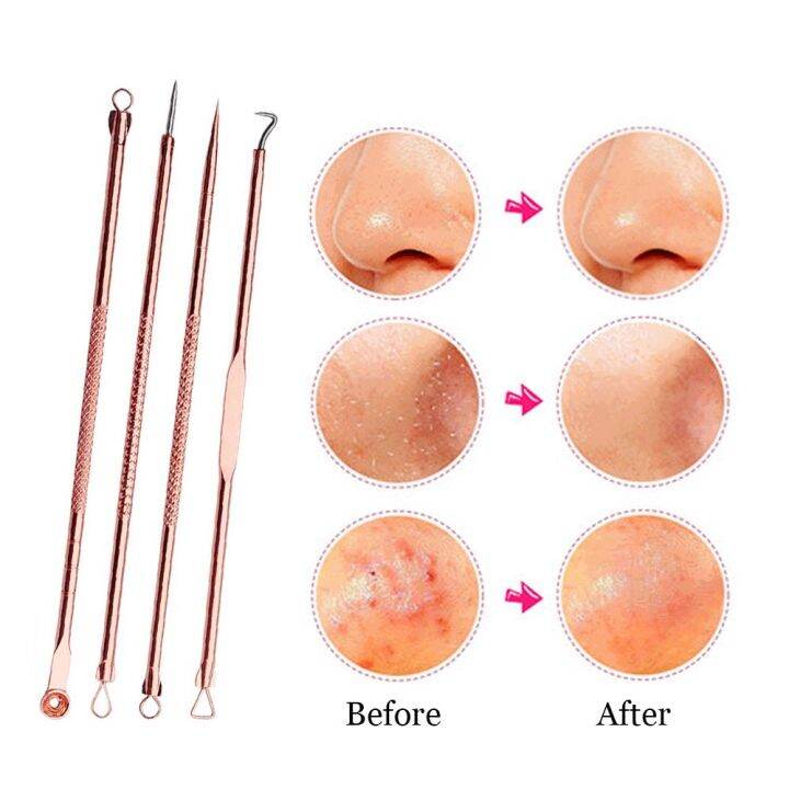 4pcs-stainless-steel-blackhead-needle-kit-acne-extractor-tool-set-fat-granule-removal-kit-with-case-for-whiteheads-comedones