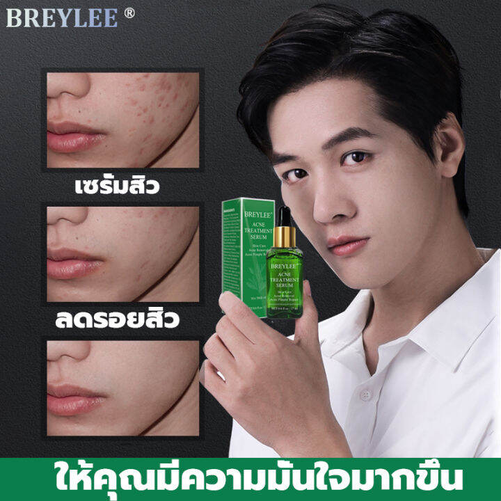 breylee-เซรั่มลดสิว17ml-เซรั่มรักษาสิว-สามารถลดสิว-บล็อกสิว-สิวไม่อักเสบ-สิวหัวขาว-สิวหัวดำ-กำจัดสิว-สิวอุดตัน-สิวผด-ไม่มีหัว-หลุมสิว-ซ่อน-ลดรอยแผลเป็นจากสิว-รอยดำจากสิว-ครีมแต้มสิว-เจลรักษาสิว-ครีมกำ