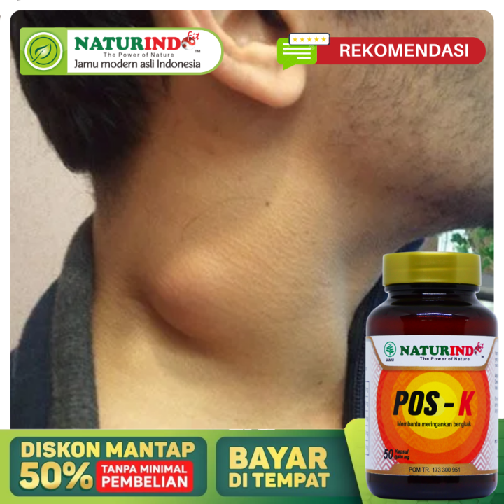 Obat Benjolan Di Leher Paling Ampuh, Kelenjar Getah Bening, Benjolan ...