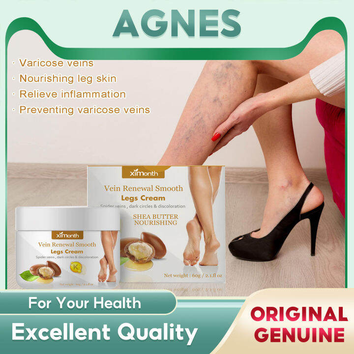 Ximonth Varicose Vein Repair Cream Tongmai Effective Relieves Leg Bulge ...