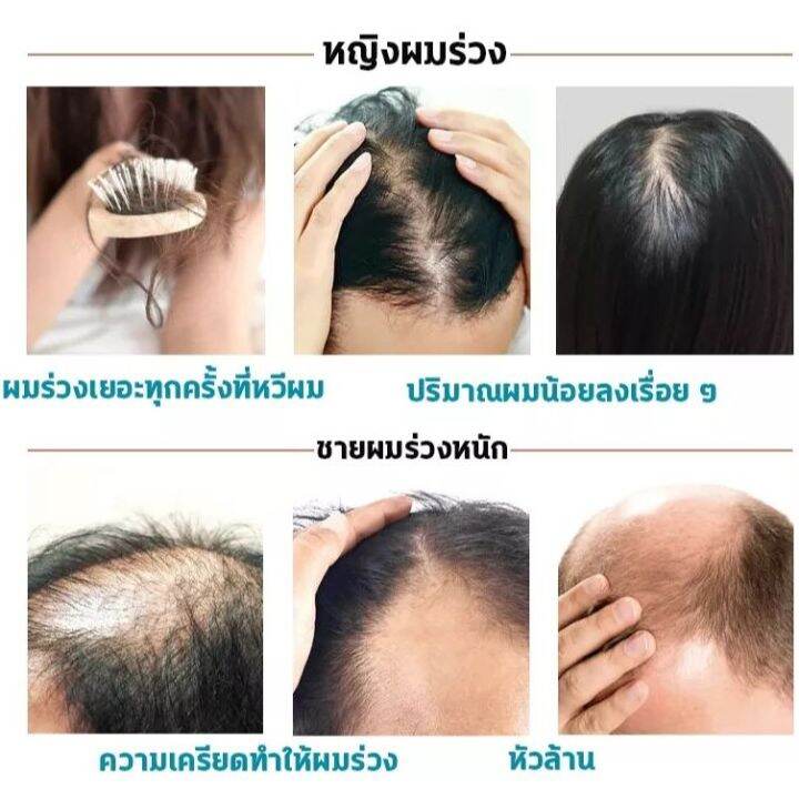 2-ขวด-1000ml-แชมพูขิง-แชมพูแก้ผมร่วง-ยับยั้งรังแค-แชมพูลดผมร่วง-แชมพูแก้ผมร่วง-แชมพูเร่งผมยาว-ยาสระผมแก้ร่วง-hair-loss-shampoo