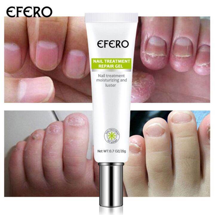EFERO Nail Fungus Serum Antifungal Nail Serum Nail Fungus Removal Toe Moisturizing and Shining