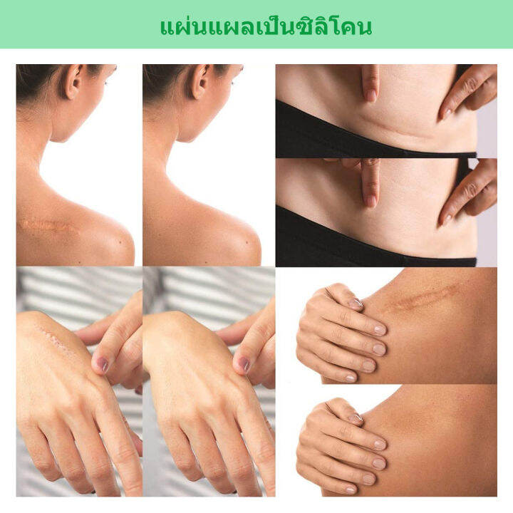 หุ้นที่มีอยู่-แผ่นแปะแผลเป็น-4pcs-ซ่อมแซมรอยแตกลาย-แผลผ่าตัด-แผลผ่าตัดหลังคลอด-สติกเกอร์ความงาม