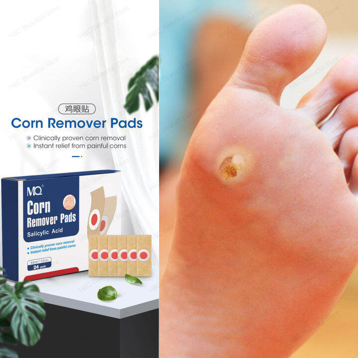 Wart Remover Pads / Corn Remover Warts Remover Corn Callus Warts And ...