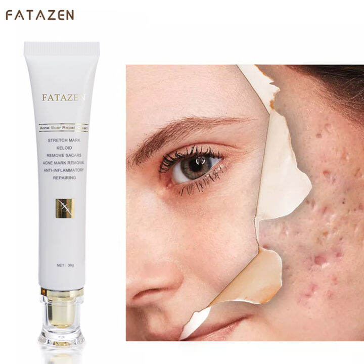 Scar cream Scar removal cream Keloid scar remover 20g Remove scars