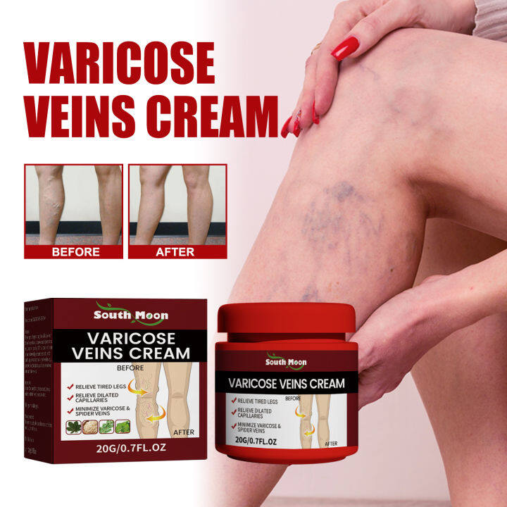 South Moon Varicose Veins Relief Cream Vasculitis Phlebitis Spider Pain ...