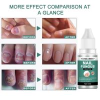 Tonisabell Nail Fluid Gentle Repair Treatment Essence 10Ml ยาสมุนไพรจีนบำรุงเซลลูไลท์กำจัด Onychomycosis Care