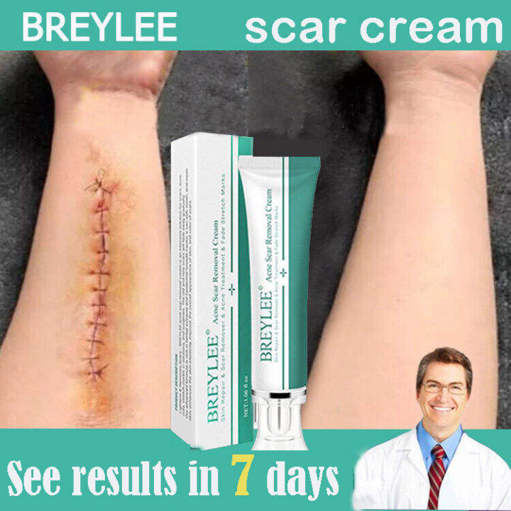BREYLEE Scar Removal Cream Acne Scar Remover Face Cream Skin Care Acne Treatment Remove Stretch