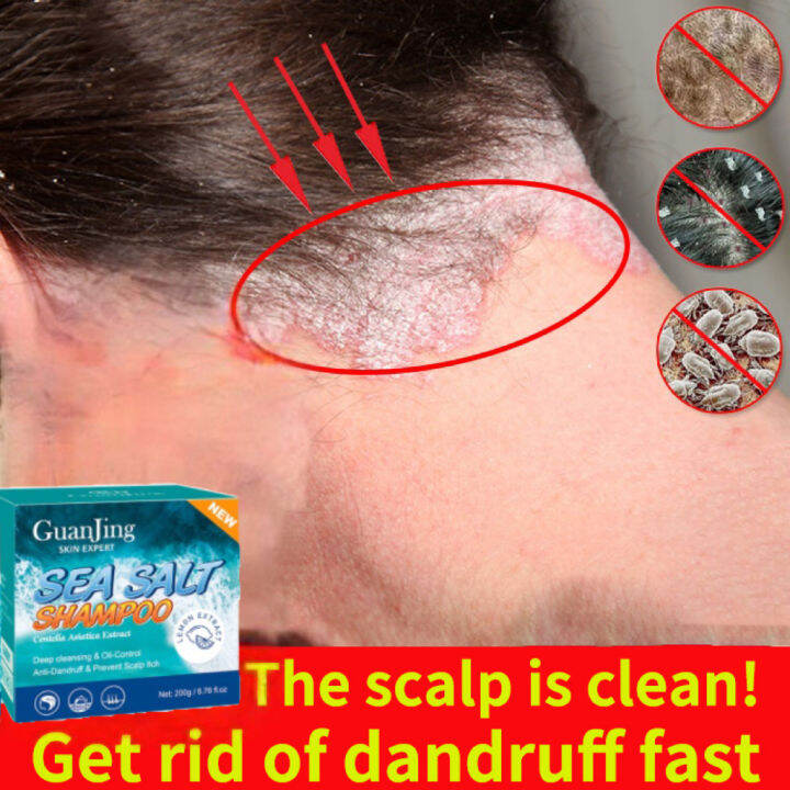 Sea Salt Shampoo Anti Dandruff Hair Treatment Shampoo Control Anti