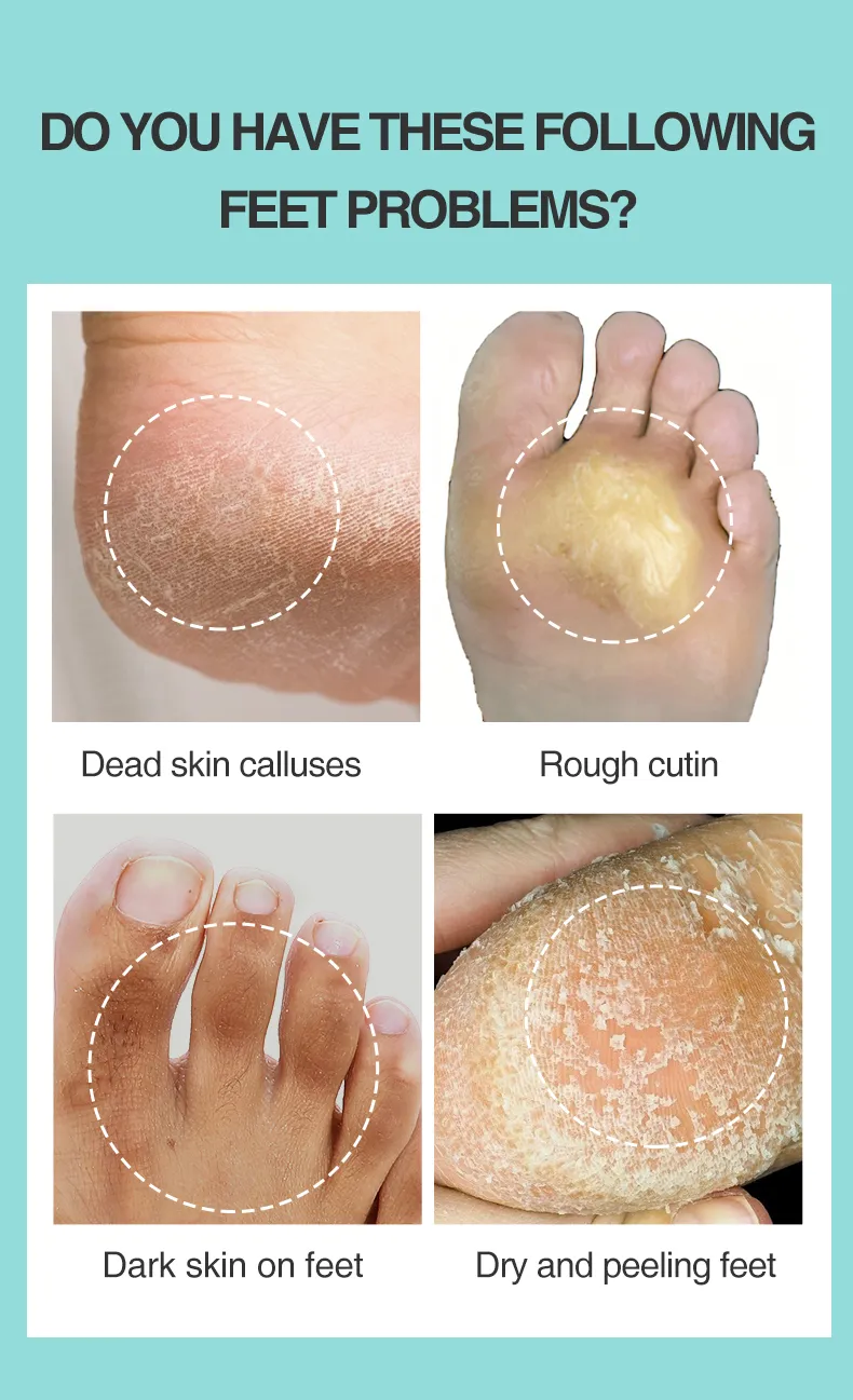 Foot Soak For Dead Skin That Actually Works atelieryuwa.ciao.jp