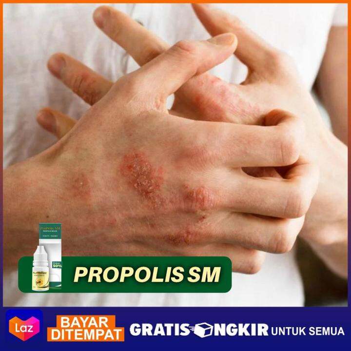 Obat Penyakit Kulit Dermatitis Numularis Ruam Kulit Bercak Merah