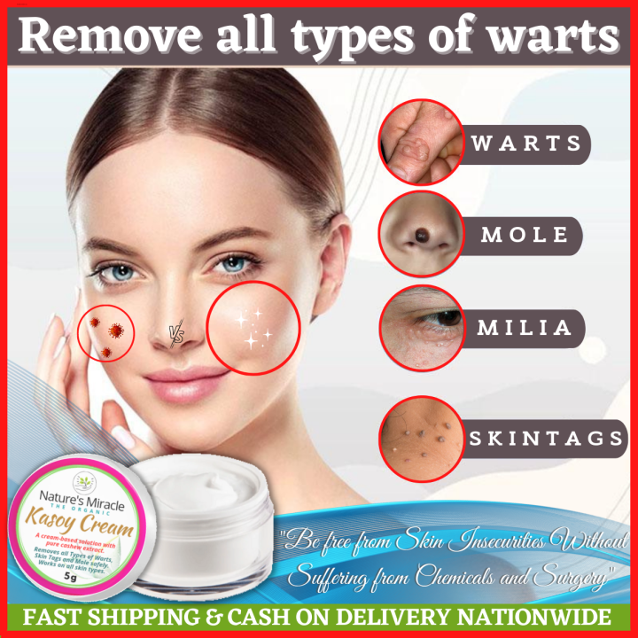 Authentic Kasoy Cream Warts Remover Very Effective And Safe Treatment ...