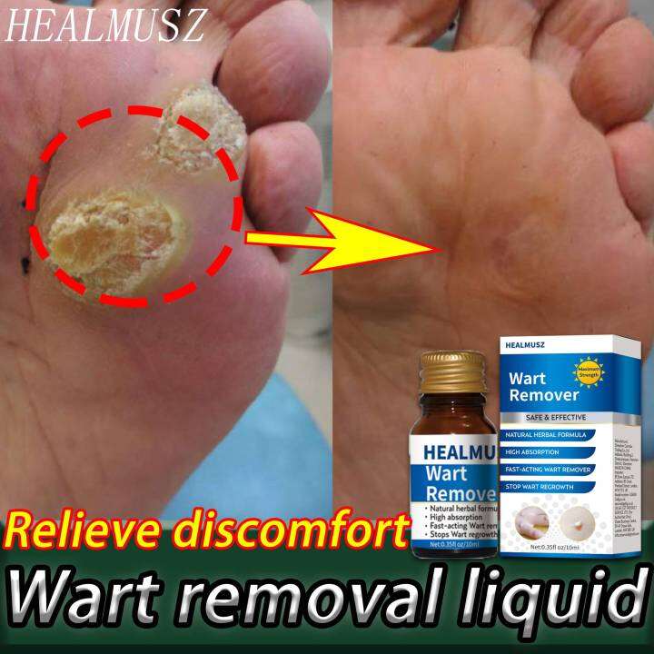 【Fast+COD】Healmusz Wart removal liquid Skin scar removal cream Wart ...