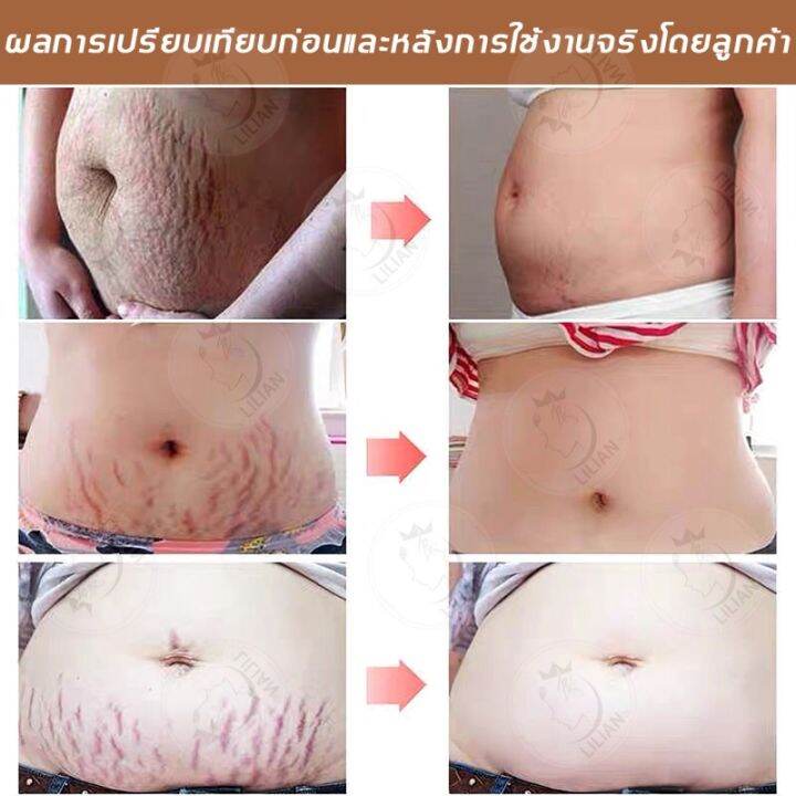 พร้อมส่งจากไทย-ครีมลดรอยแตก-50g-ครีมทาท้องลาย-อ่อนโยนไม่ระคายเคือง-ครีมกันแตกลาย-แก้แตกลาย-ครีมทารอยแตกลาย-ครีมทาหลังคลอด-ยาทารอยแตกลาย-ครีมแก้ท้องลาย-ครีมท้องลาย