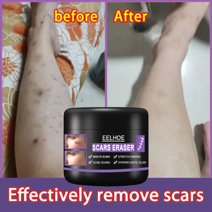 50g Eelhoe Scar Cream Original Scar Remover Peklat Remover Cream Original Acne Scar Remover 5450