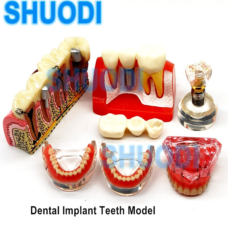 SHUODI Dental Overdenture Superior Upper with 4 Implant Restoration Teeth Study Teach Model 