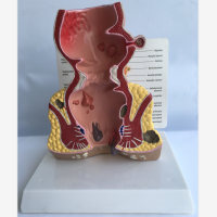 รูปแบบโรคของ Rectum Model Rectum Anatomical Model