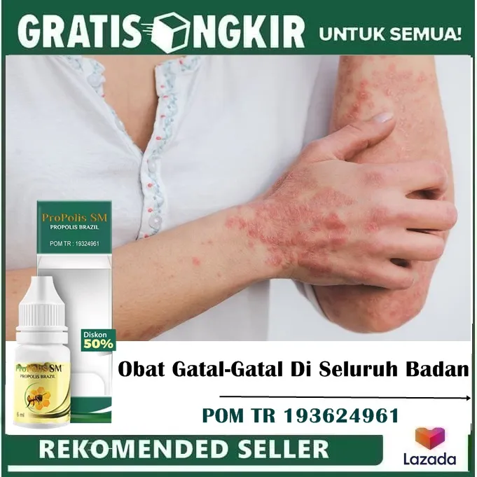 Obat Gatal-Gatal Di Seluruh Badan, Obat Gatal Karena Alergi, Eksim ...