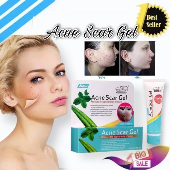 Newest and Effective!! Acne Scar Gel/Remove Scar Acne Fade Stretch ...