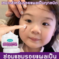 【สินค้านำเข้า】ครีมทาแผลเป็น ทาแผลคีลอยด์ ลดแผลเป็น ครีมทาแผลผ่าคลอด ลดแผลไฟไหม้ รอยสิว แผลผ่าตัดเป็นต้น（ครีมทารอยแผลเป็น ครีมลดรอยแผลเป็น ครีมลดรอยสิว ครีมลดแผลเป็น ครีมกำจัดรอยแผลเป็น ครีมลดรอยแผลเป็น ครีมทาแผลเป็น ครีมลดรอยสิว ครีมลดแผลเป็น Scar cream）