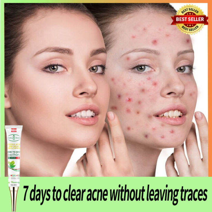 【COD】Acne cream pimple eraser pimple marks remover pimple remover anti