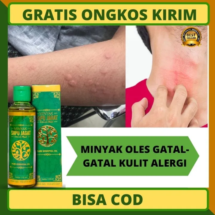 Obat Luar Gatal Alergi Sekujur Badan Minyak Untuk Gatal Bentol Minyak Penghilang Gatal Obat Gatal Kulit