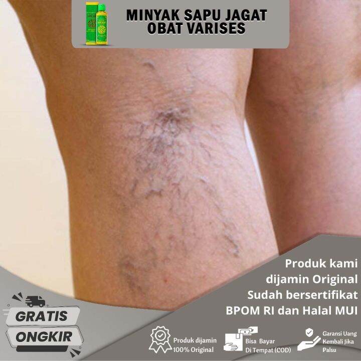 Obat Varises Varises di Betis Kaki Obat Varises di Tangan dan Kaki