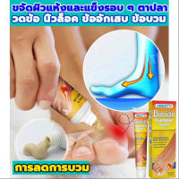 เห็นผลไว Bunion cream ลดปวด ลดอักเสบ นิ้วโป้งโค้งงอเข้า Hallux valgus ปวดเท้า ปวดข้อ ปวดบวม ข้ออักเสบ ข้อบวม ข้อต่อนิ้วเท้า บรรเทาอาการ บรรเทาปวด ค