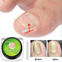 Nail Ingrown Corrector Nail Patch Correction Tube Pad Patch Corrector Nail Treatments Toenail Straightening Correctors Foot Care