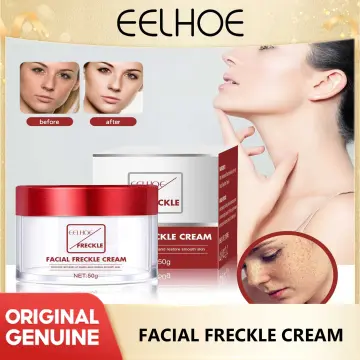 Powerful whitening freckle cream Chinese herbal plant face cream remove  freckles and dark spots 30g Skin whitening cream : : Beauty